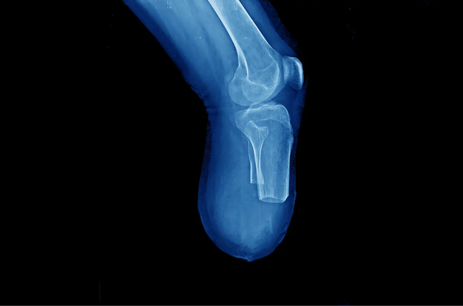 HEALTHY BONE